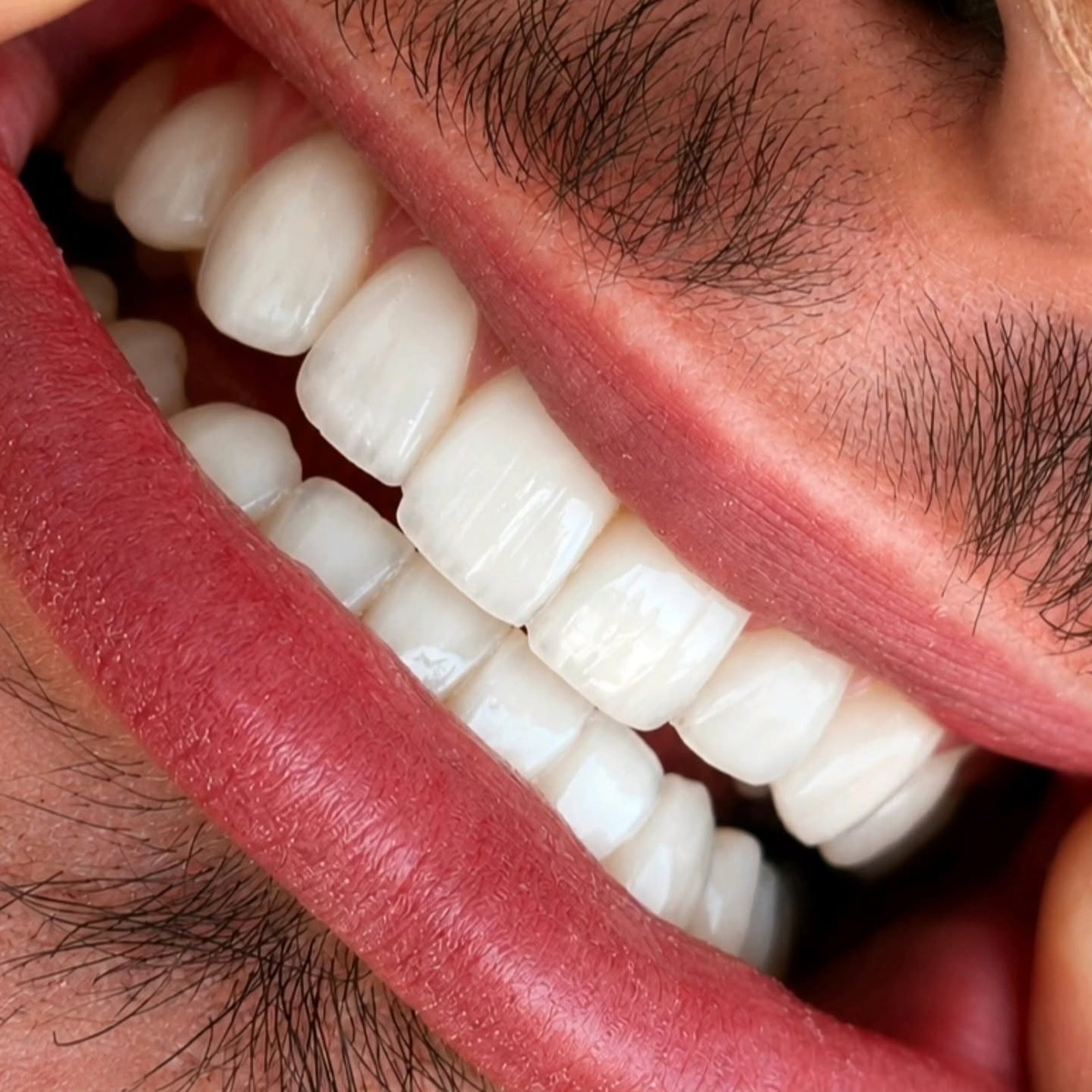 Detalhe de facetas em porcelana